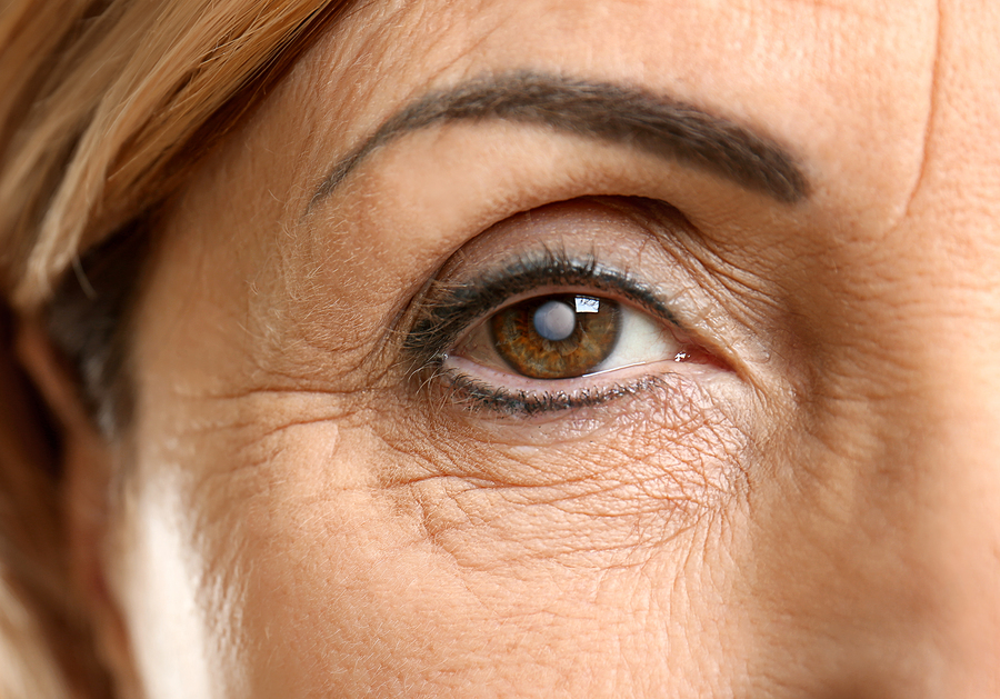 Symptoms of Cataracts